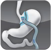 Mini-Gastric Bypass