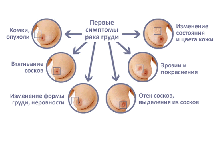 симптомы рака молочной железы
