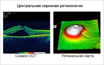 Центральная серозная хориоретинопатия Центральная серозная хориоретинопатия