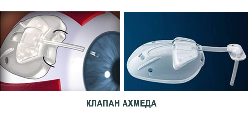 kla.jpg kla.jpg